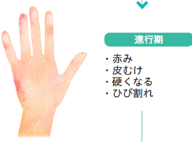 指紋が薄くなる原因、その対策と予防法