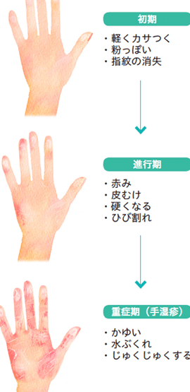 指紋が薄くなる原因、その対策と予防法 1 e68c87e7b48be3818ce89684e3818fe381aae3828be58e9fe59ba0e38081e3819de381aee5afbee7ad96e381a8e4ba88e998b2e6b395